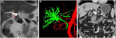 The management of a duodenal fistula involving the right hepatic duct: a rare case report